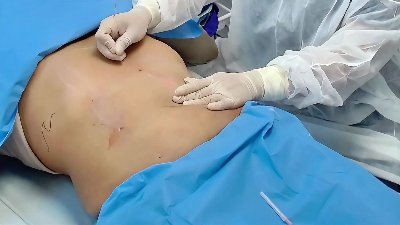Endolift® para Tratamento de flacidez abdominal